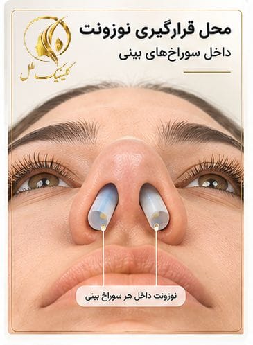 محل قرارگیری نوزونت داخل سوراخ&zwnj;های بینی