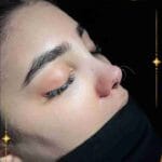 عمل رینوپلاستی بینی