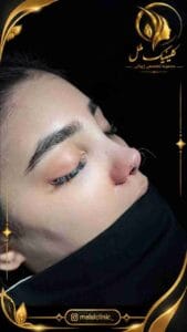 عمل رینوپلاستی بینی