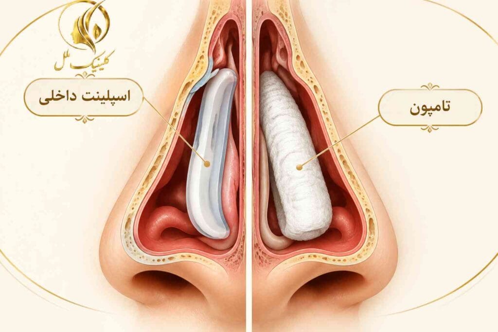عمل بینی بدون تامپون و تفاوت آن با تامپون بینی