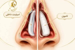 عمل بینی بدون تامپون و تفاوت آن با تامپون بینی