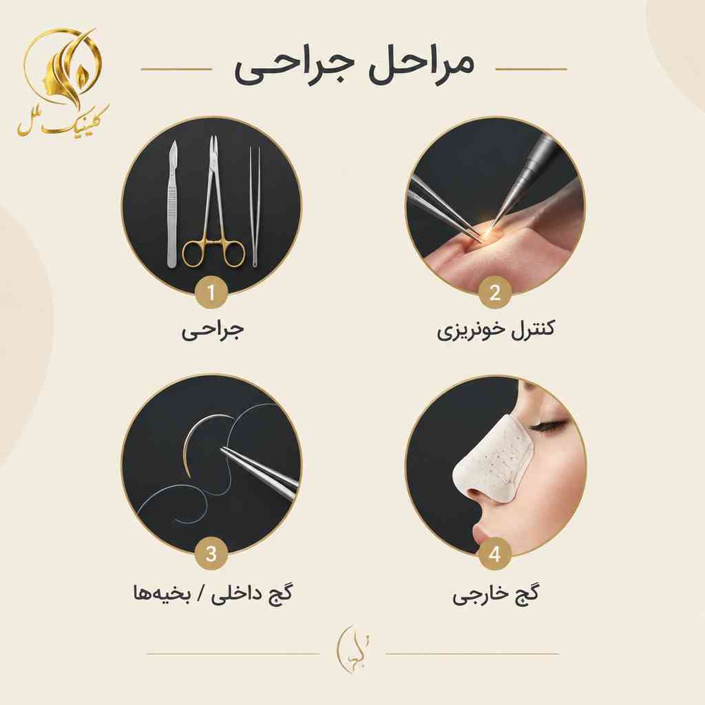 مراحل عمل بینی بدون تامپون و روش کنترل خونریزی