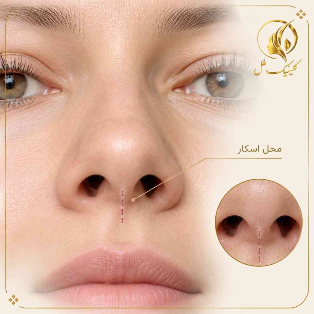 scar-removal-nosejob01 جای زخم عمل بینی و محل ایجاد اسکار بعد از رینوپلاستی