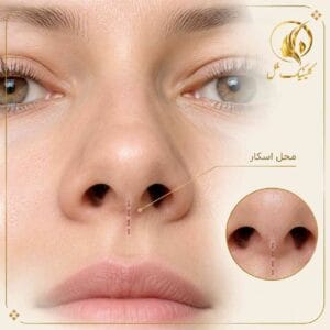جای زخم عمل بینی و محل ایجاد اسکار بعد از رینوپلاستی
