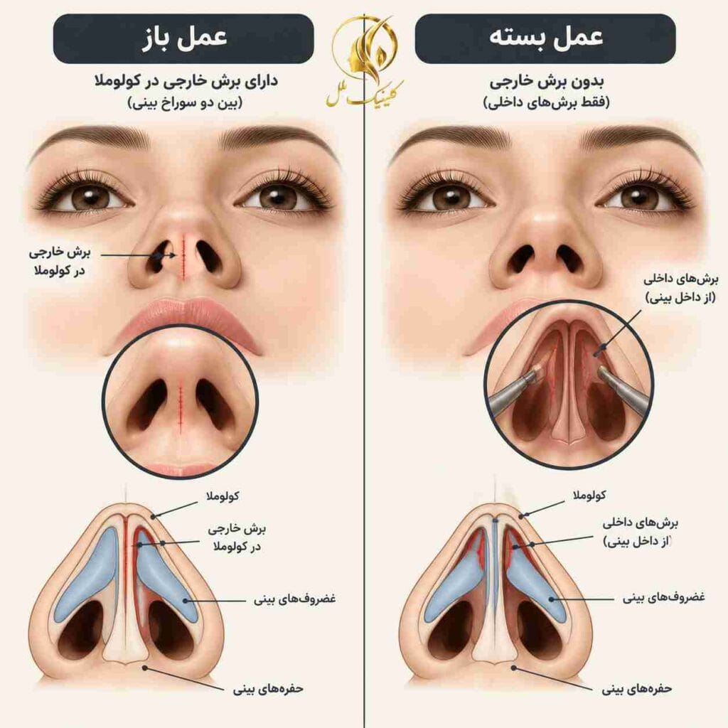 scar-removal-nosejob02 تفاوت محل برش و جای زخم در عمل بینی باز و بسته