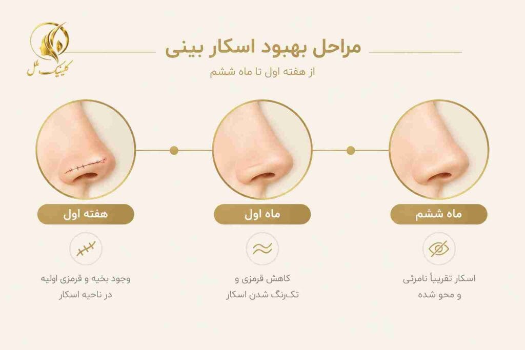 scar-removal-nosejob03 مراحل ترمیم جای زخم عمل بینی از هفته اول تا ماههای بعد