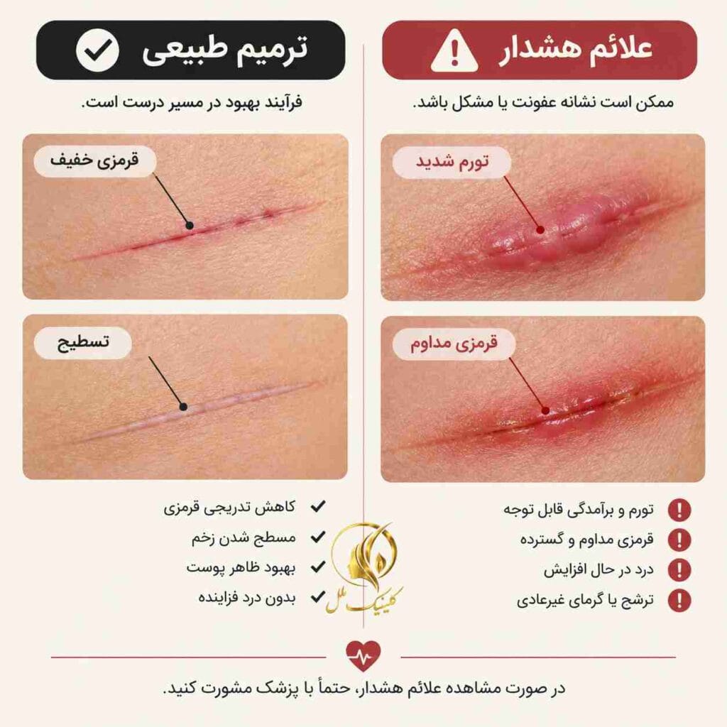 scar-removal-nosejob04 تفاوت روند طبیعی ترمیم با علائم هشدار جای زخم بینی