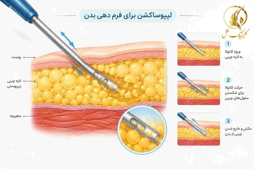 لیپوساکشن برای فرم دهی بدن
