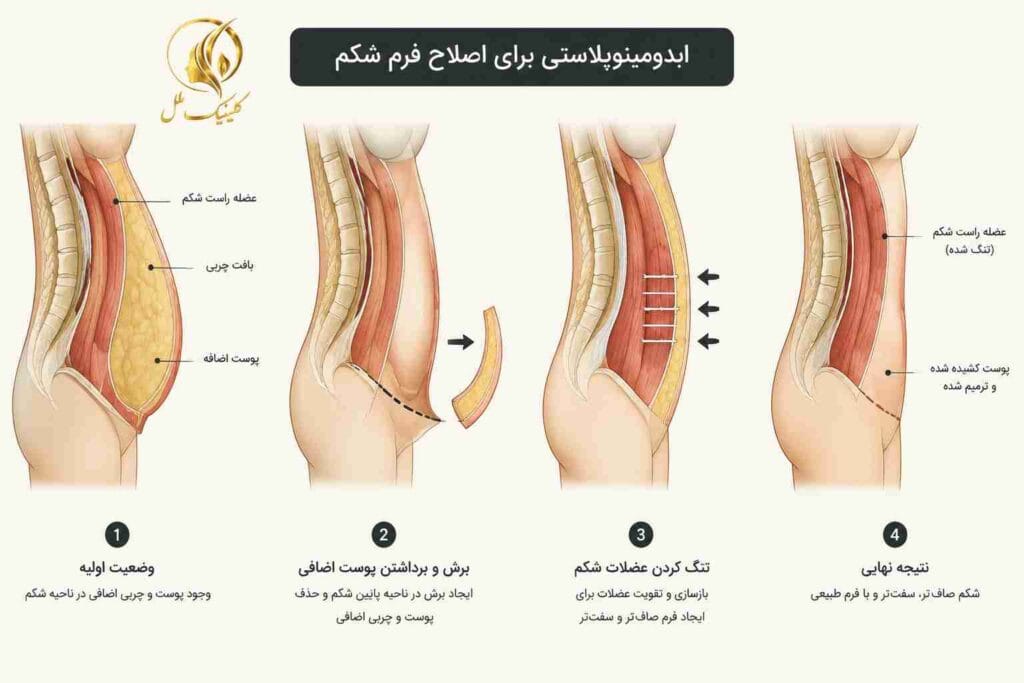 ابدومینوپلاستی برای اصلاح فرم شکم