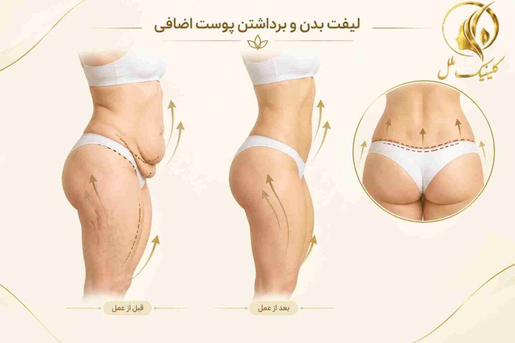 لیفت بدن و برداشتن پوست اضافی