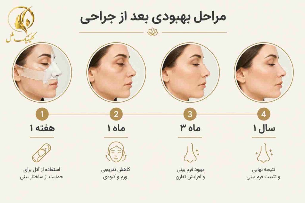 septorhinoplasty-6 مراحل بهبودی بعد از سپتورینوپلاستی
