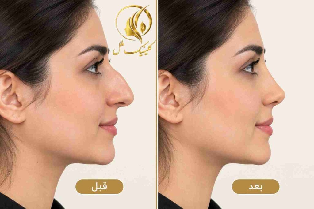 septorhinoplasty-9 نمونه نتیجه سپتورینوپلاستی قبل و بعد از جراحی