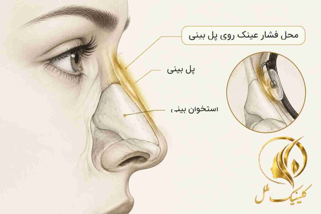 محل فشار عینک روی پل بینی بعد از رینوپلاستی