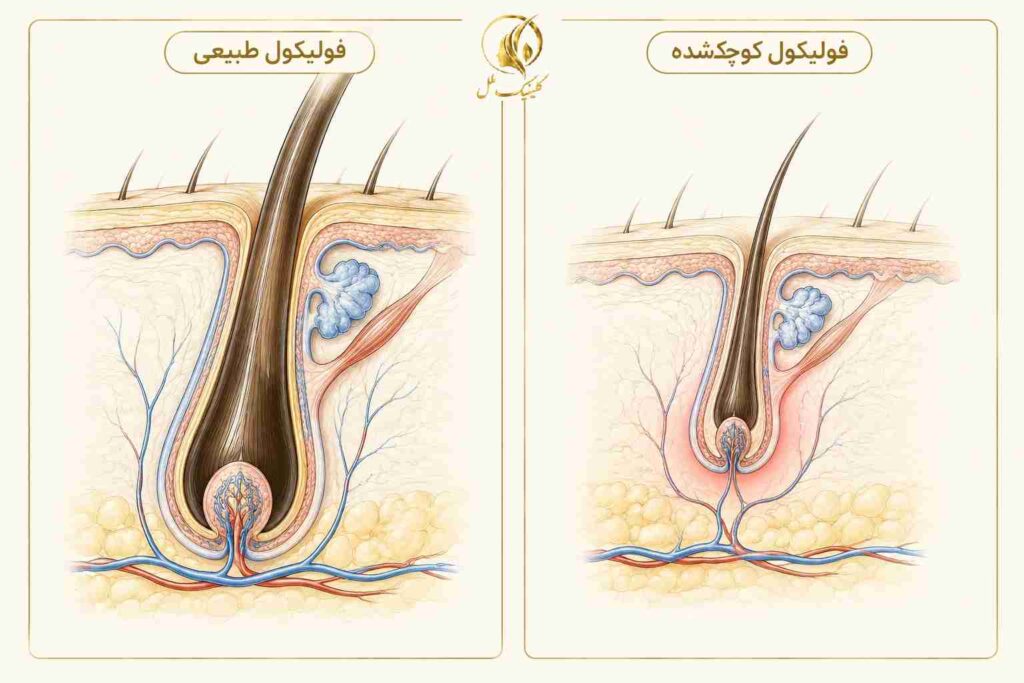 مقایسه فولیکول طبیعی مو با فولیکول کوچک&zwnj;شده در آلوپسی آندروژنیک