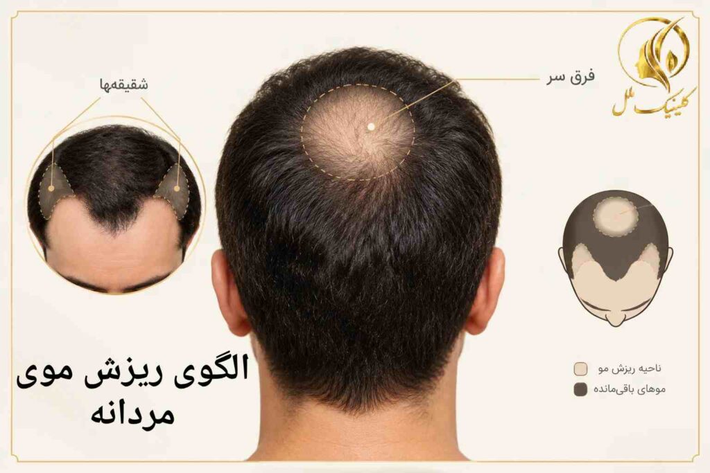 الگوی معمول عقب&zwnj;رفتن خط رویش و کم&zwnj; پشتی فرق سر در ریزش موی آندروژنیک مردان