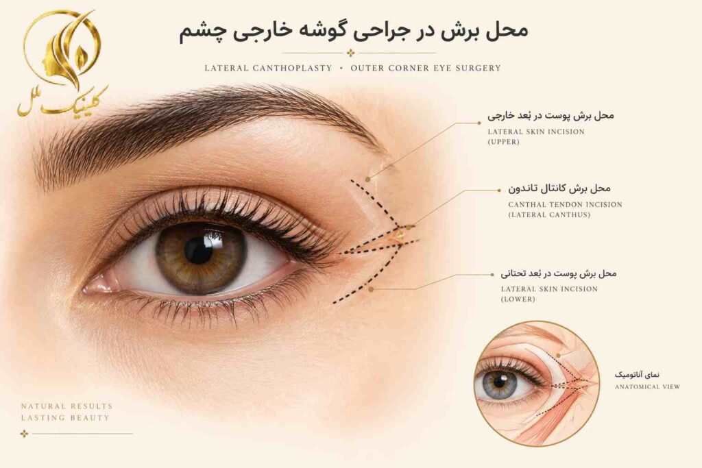 تصویر آموزشی محل احتمالی برش در جراحی گوشه خارجی چشم