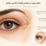 تصویر آموزشی محل احتمالی برش در جراحی گوشه خارجی چشم