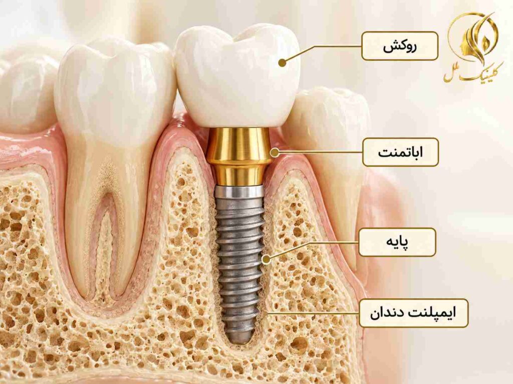 ایمپلنت دندان و ساختار روکش آن