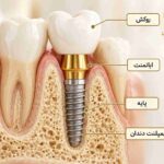 ایمپلنت دندان و ساختار روکش آن