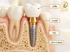 ایمپلنت دندان و ساختار روکش آن
