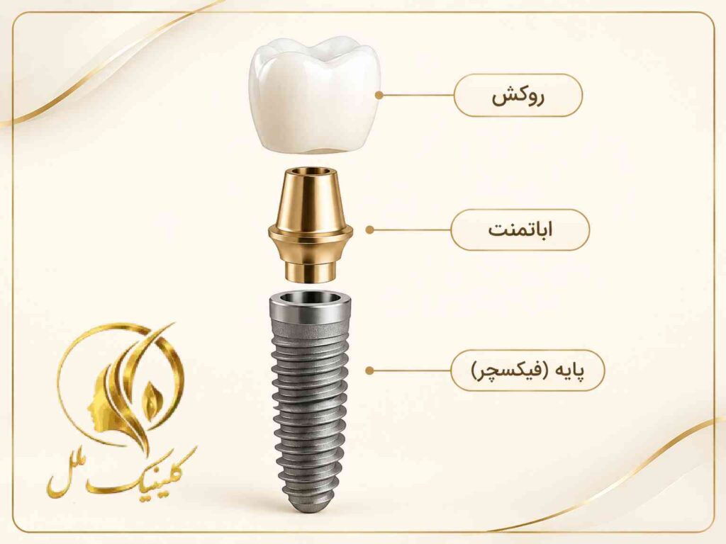 اجزای ایمپلنت دندان شامل پایه، اباتمنت و روکش
