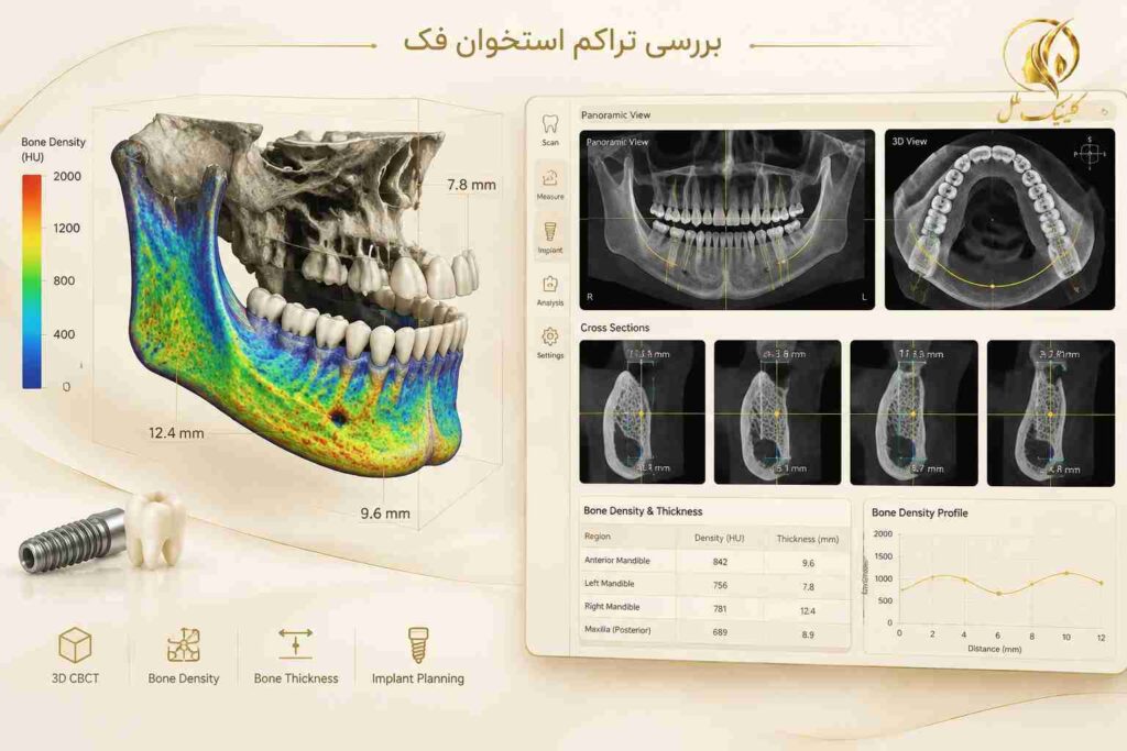 بررسی استخوان فک برای برنامه&zwnj;ریزی ایمپلنت