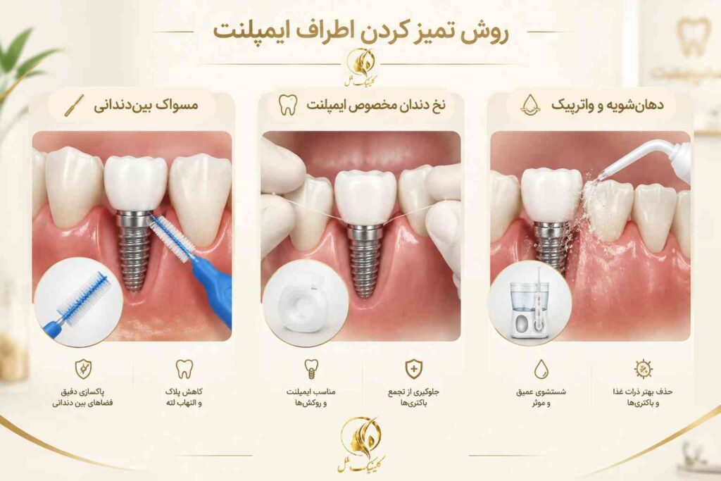 روش تمیز کردن اطراف ایمپلنت دندان