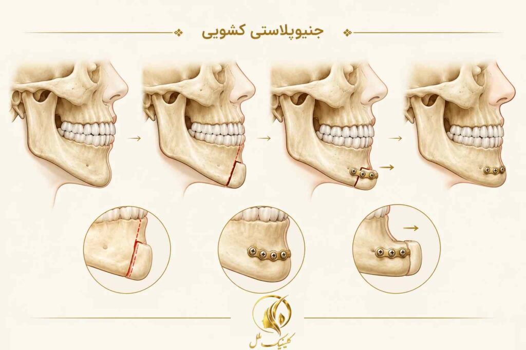 difference-genioplasty-jaw-surgery-02 نمای شماتیک جابهجایی استخوان چانه در جنیوپلاستی کشویی