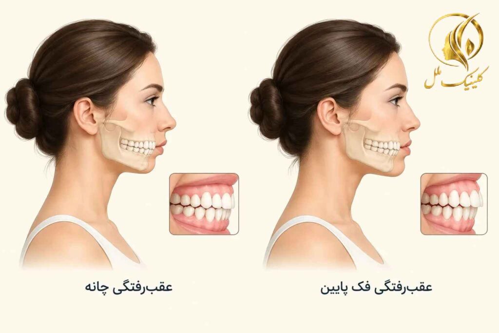 difference-genioplasty-jaw-surgery-04 مقایسه شماتیک عقبرفتگی چانه با عقبرفتگی فک پایین