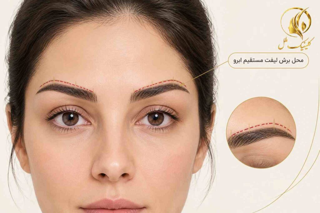 نمای شماتیک محل برش در جراحی لیفت دایرکت ابرو
