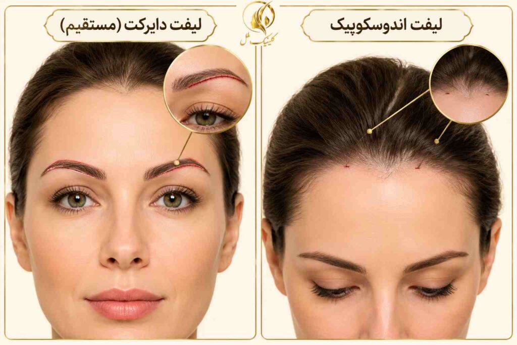 مقایسه محل برش در لیفت دایرکت و لیفت اندوسکوپیک ابرو