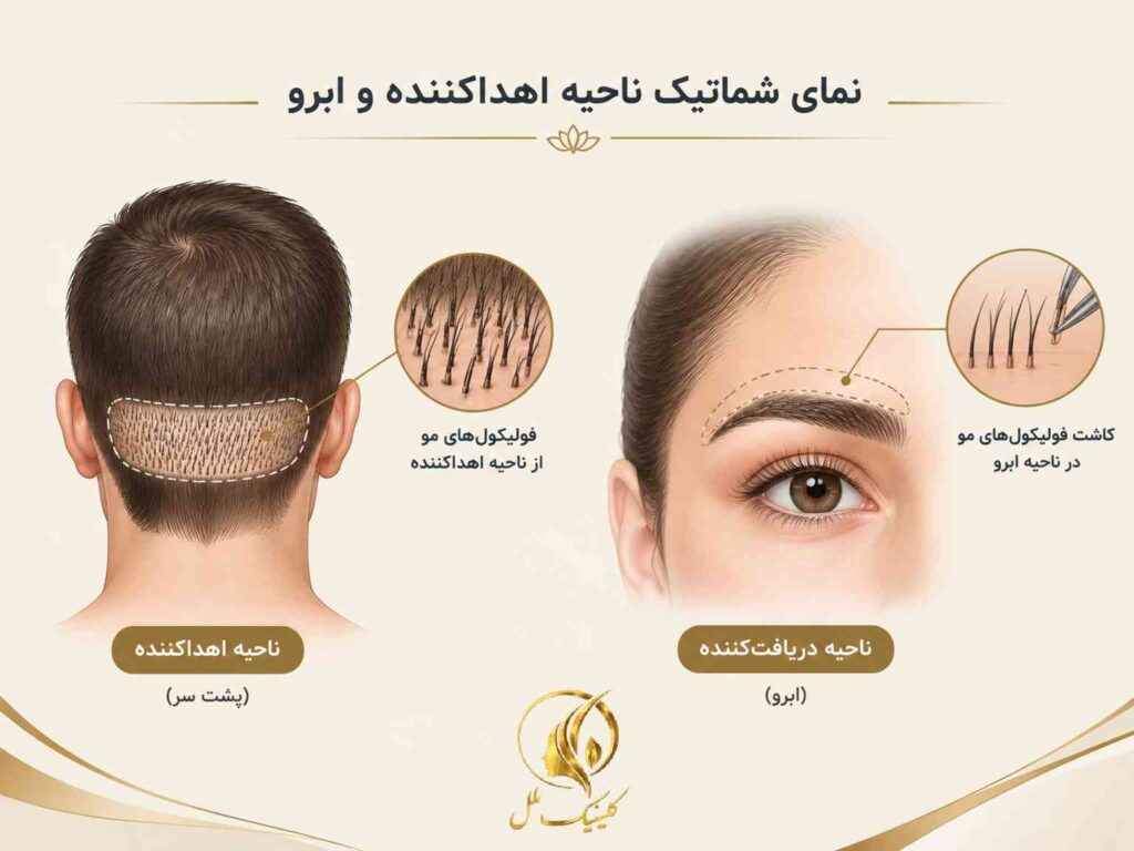 نمای شماتیک ناحیه اهداکننده و ابرو