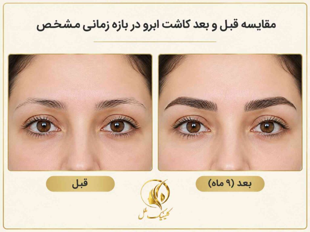 مقایسه قبل و بعد کاشت ابرو در بازه زمانی مشخص