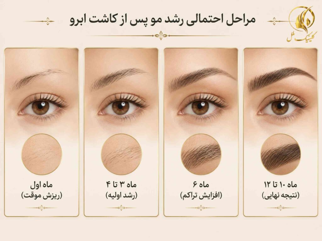 مراحل احتمالی رشد مو پس از کاشت ابرو