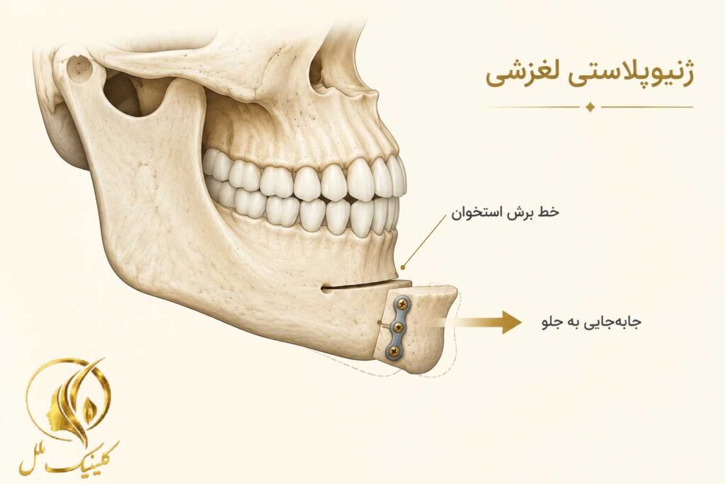 نمای شماتیک جابه&zwnj;جایی استخوان چانه در ژنیوپلاستی لغزشی
