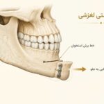 نمای شماتیک جابه&zwnj;جایی استخوان چانه در ژنیوپلاستی لغزشی