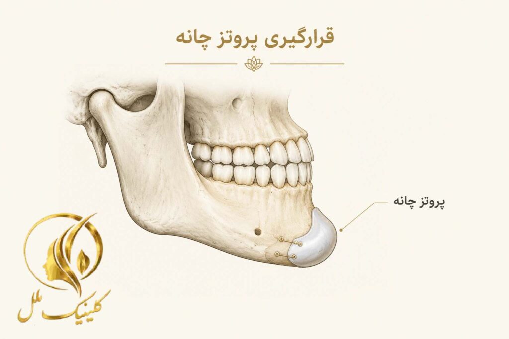 نمای شماتیک محل قرارگیری پروتز روی استخوان چانه