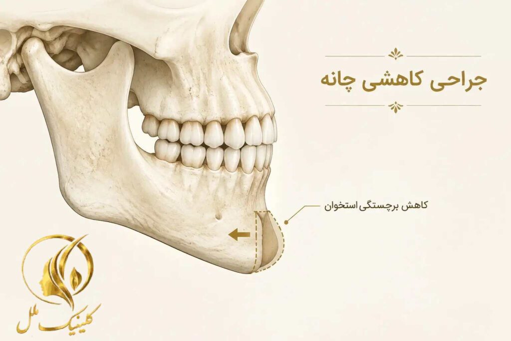 تصویر آموزشی کاهش برجستگی استخوان چانه در جراحی کاهشی