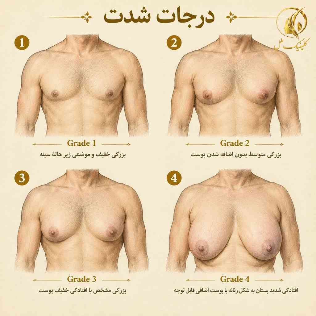 نمای شماتیک تفاوت درجات شدت بزرگی سینه در مردان