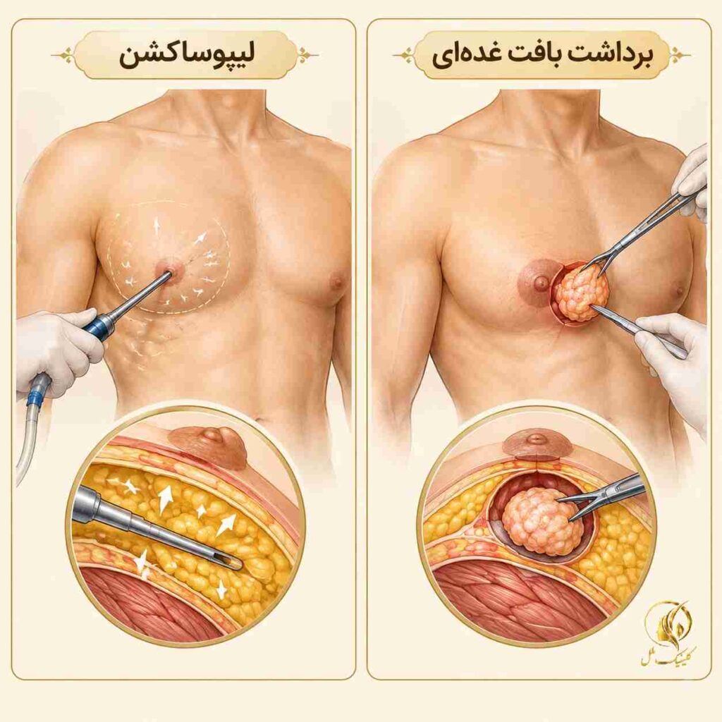 مقایسه شماتیک لیپوساکشن و برداشت بافت غده&zwnj;ای