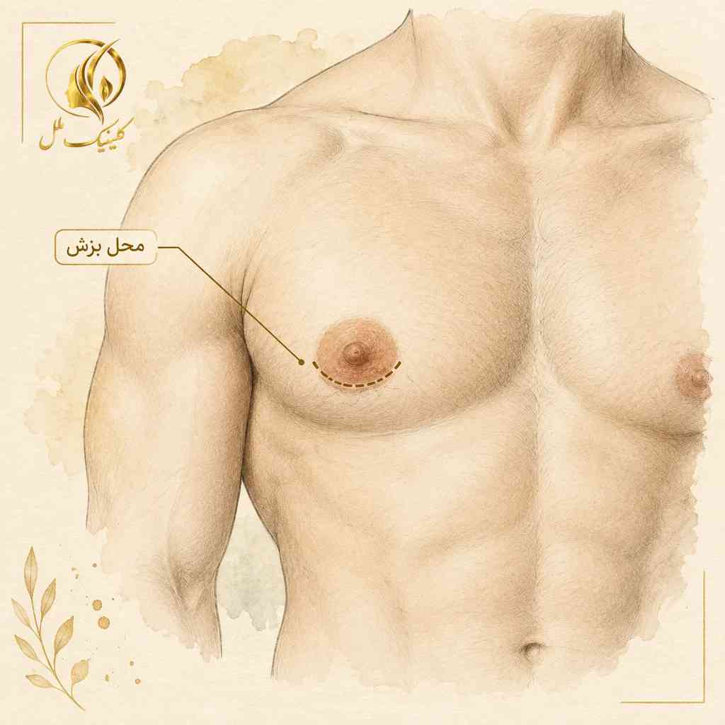 نمای شماتیک محل احتمالی برش اطراف هاله در برخی روش&zwnj;ها