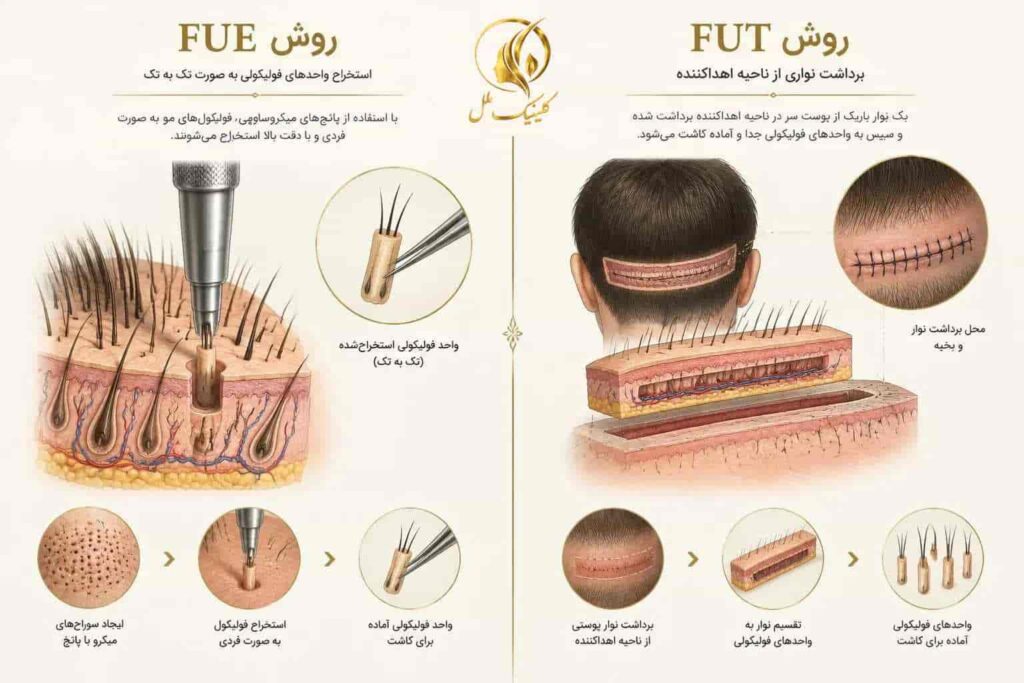 مقایسه شماتیک برداشت فولیکول در روش&zwnj;های FUE و FUT