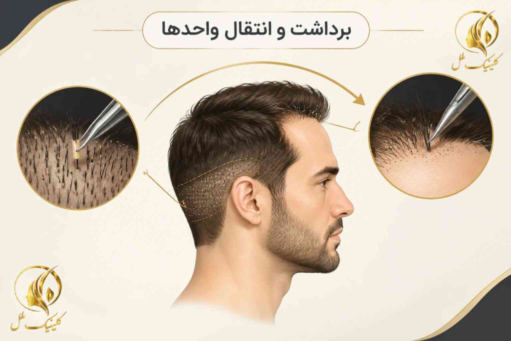 نمای شماتیک برداشت واحدهای فولیکولی از بانک مو و انتقال به ناحیه کم&zwnj; پشت در روش FIT