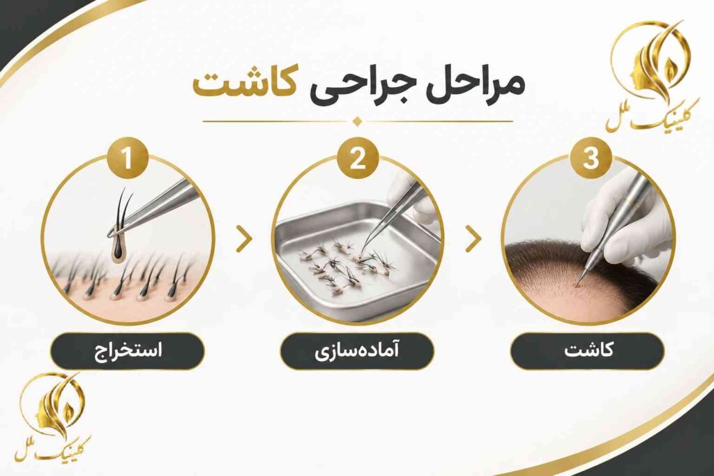 مراحل برداشت گرافت مو، آماده&zwnj;سازی فولیکول و کاشت در ناحیه گیرنده