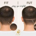 مقایسه شماتیک اسکارهای نقطه&zwnj;ای روش برداشت تکی با اسکار خطی برداشت نواری FUT