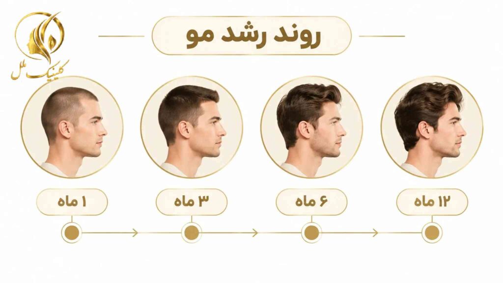 نمای آموزشی مراحل زمانی بهبودی و رشد تدریجی مو پس از کاشت