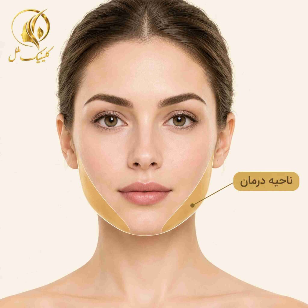 jawline-contouring-05 تصویر آموزشی تزریق فیلر در ناحیه خط فک