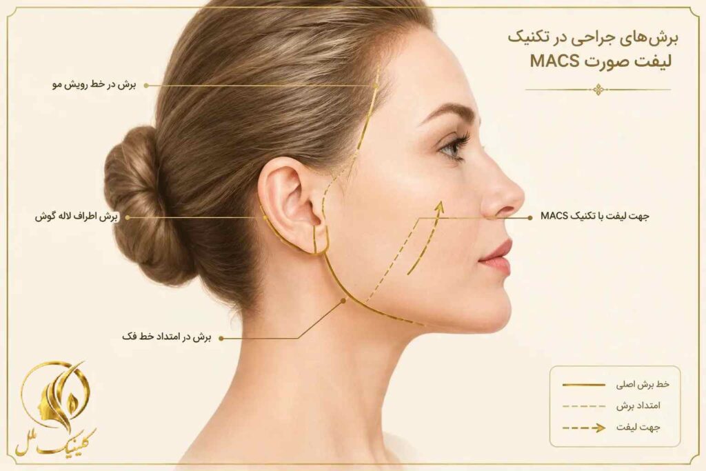 max-lift-02 نمای آموزشی محل برش در تکنیک MACS