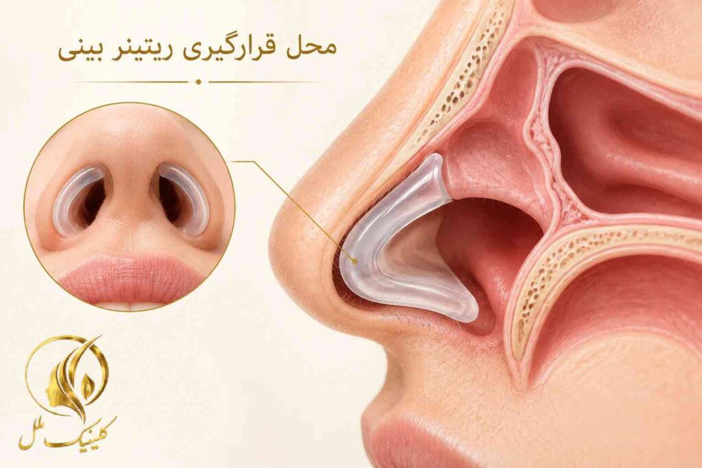 تصویر آموزشی محل قرارگیری ریتینر داخل سوراخ بینی