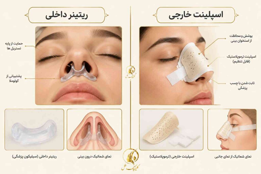 مقایسه آموزشی ریتینر داخل بینی و اسپلینت خارجی بینی